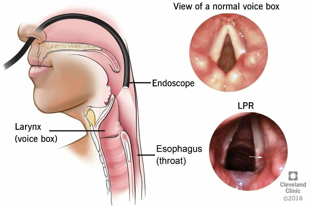 Признаки рака горла и гортани фото Acid reflux and your throat Vinmec