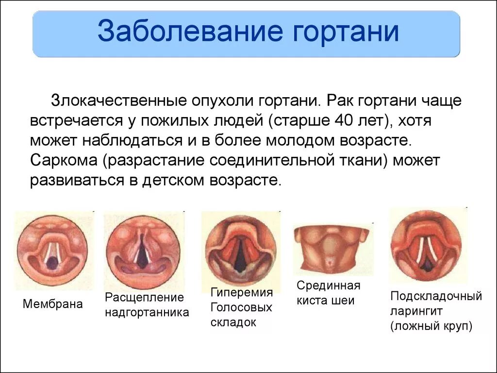 Признаки рака горла у мужчин фото Хондроперихондрит гортани