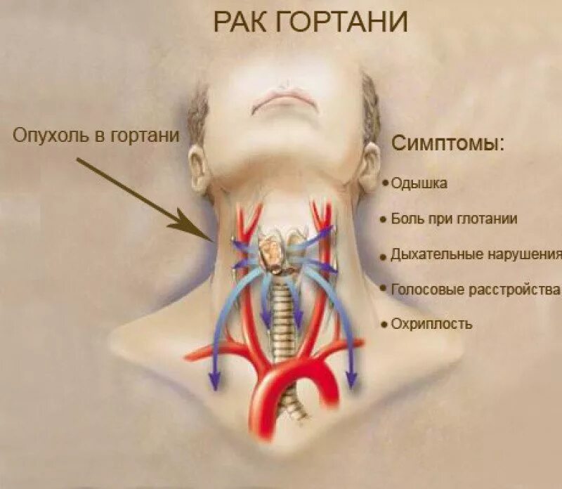 Признаки рака горла у мужчин фото Рак гортани - признаки, причины, симптомы, лечение и профилактика - iDoctor.kz