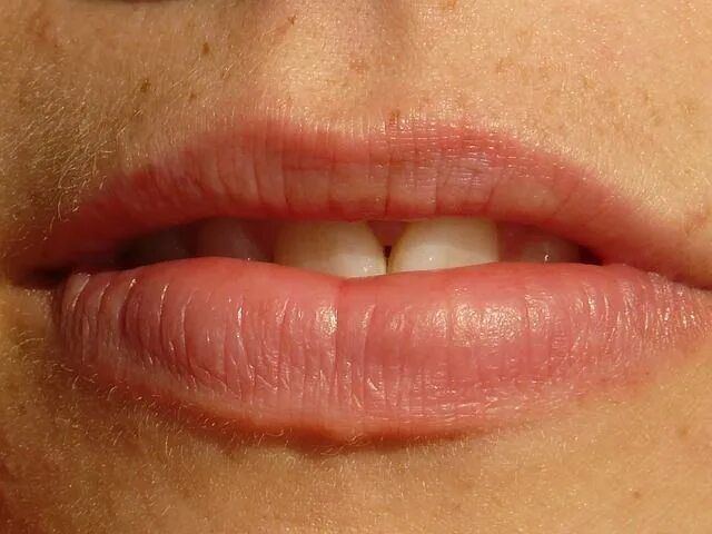 Признаки рака губы симптомы и фото 10 Ways to Quickly Get Rid of Cracked, Dry Lips Sjogrens syndrome, Sjogrens, Bad