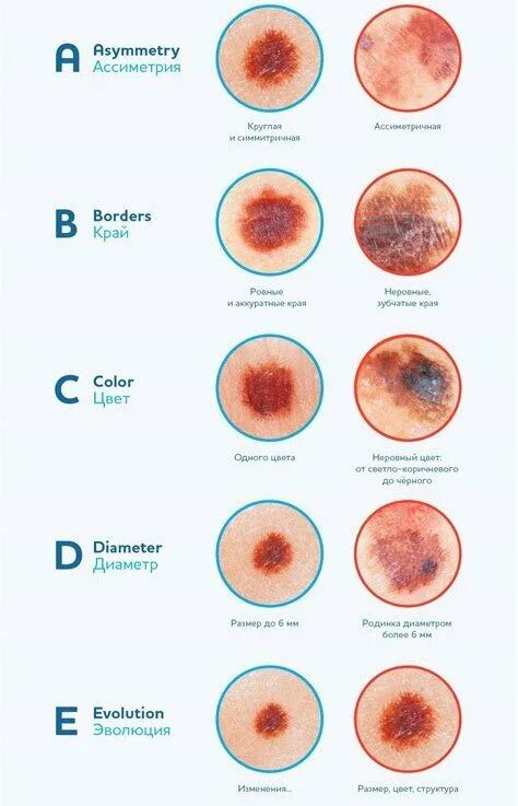 Признаки рака кожи фото начальная стадия Критерии ABCDE как оценка риска развития меланомы Медицинские записки Дзен