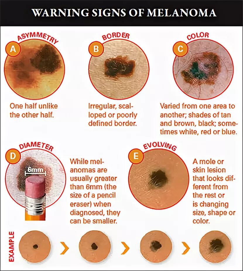 Признаки рака кожи фото начальная стадия Warning Signs of Melanoma - ABCDEs