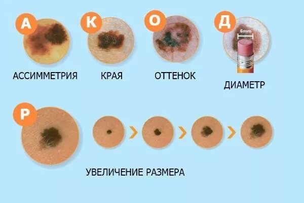 Признаки рака кожи фото начальная стадия Родинка или опухоль? - Поликлиника Сканер