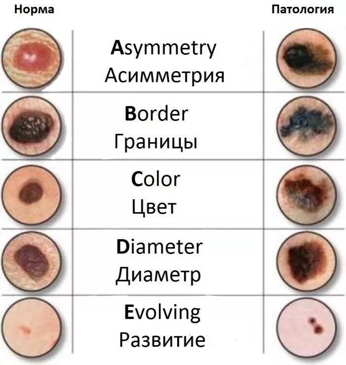 Признаки рака кожи фото начальная стадия Обследуйте родинки - сохраните свою жизнь! - Онкологический центр имени Н.П. Нап