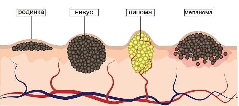 Признаки рака кожи у мужчин симптомы фото Болезнь Паркинсона и меланома - Клиника восстановительной неврологии " Новости