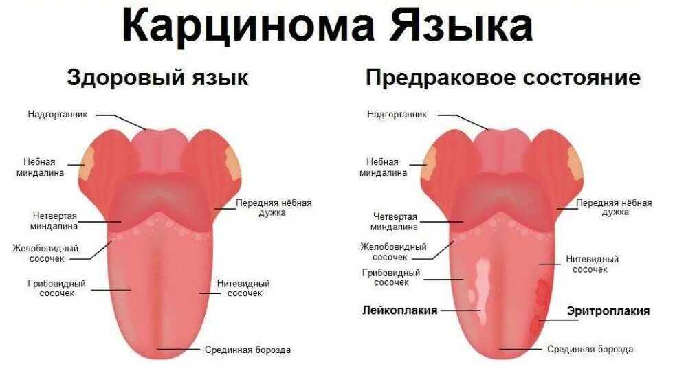 Признаки рака полости рта симптомы фото Рак ротовой полости: первые признаки и причины возникновения