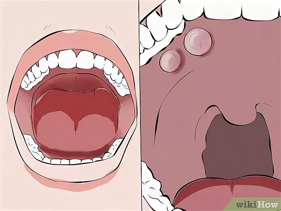 Признаки рака языка у женщин симптомы фото How to Recognize Signs of Oral Cancer: 11 Steps (with Pictures)