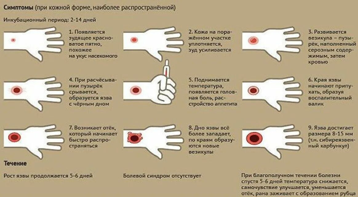 Признаки сибирской язвы фото Сибирская язва - Глубокский районный центр гигиены и эпидемиологии