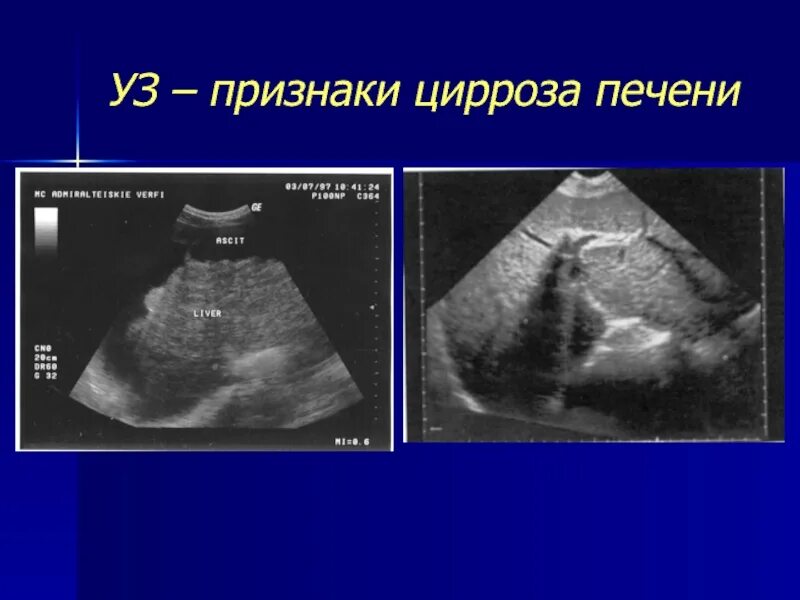 Признаки цирроза печени у женщин фото Симптомы при циррозе печени у женщины какие: найдено 90 изображений