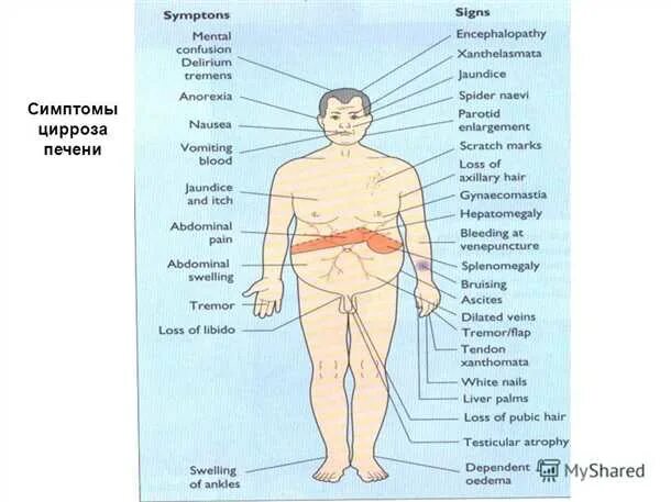 Признаки цирроза печени у женщин фото Признаки цирроза печени у мужчин: симптомы, причины и лечение Медицинская Энцикл