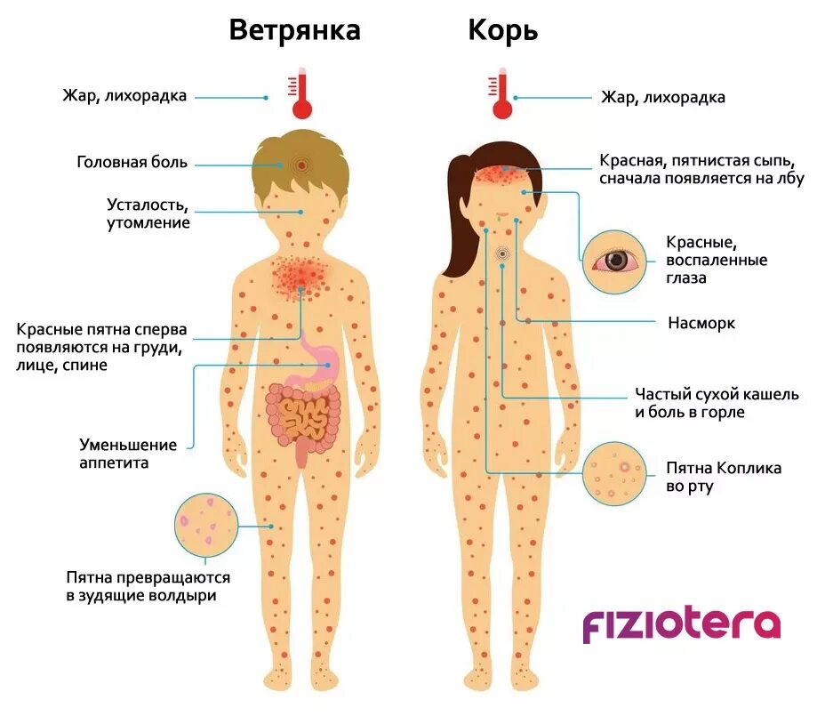 Признаки ветрянки у взрослых симптомы фото Ветряная оспа (ветрянка): симптомы, диагностика и лечение - Физиоцентр