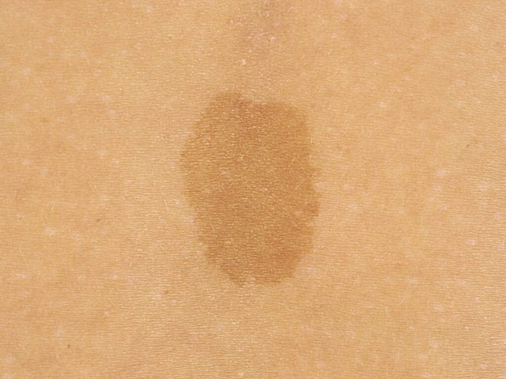 Проба на лишай йодом у человека фото Онко Вики - Нейрофиброматоз 1 типа