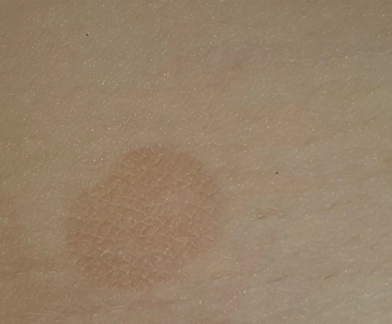 Проба на лишай йодом у человека фото Коричневое пятнышко на теле - Вопрос дерматологу - 03 Онлайн