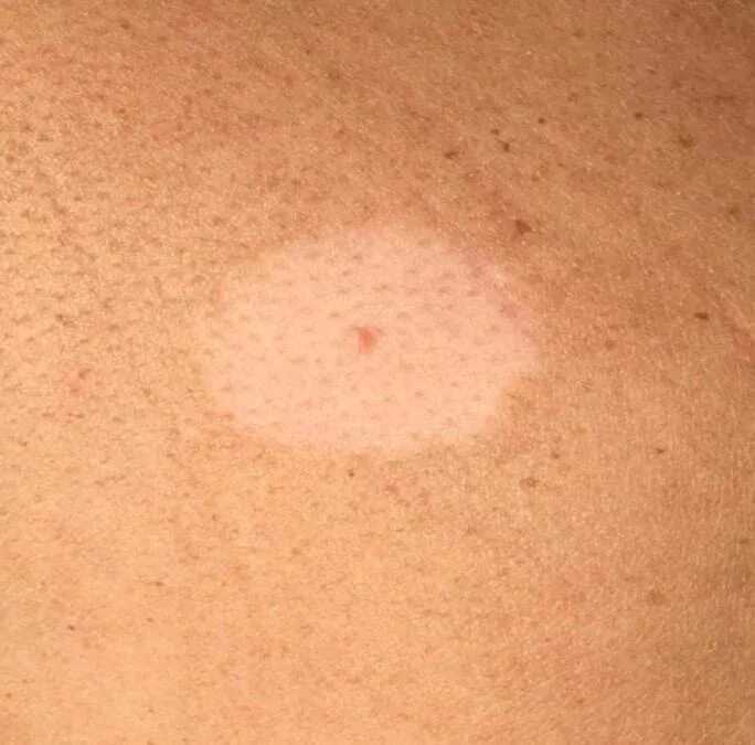 Проба на лишай йодом у человека фото Что такое лишай у человека