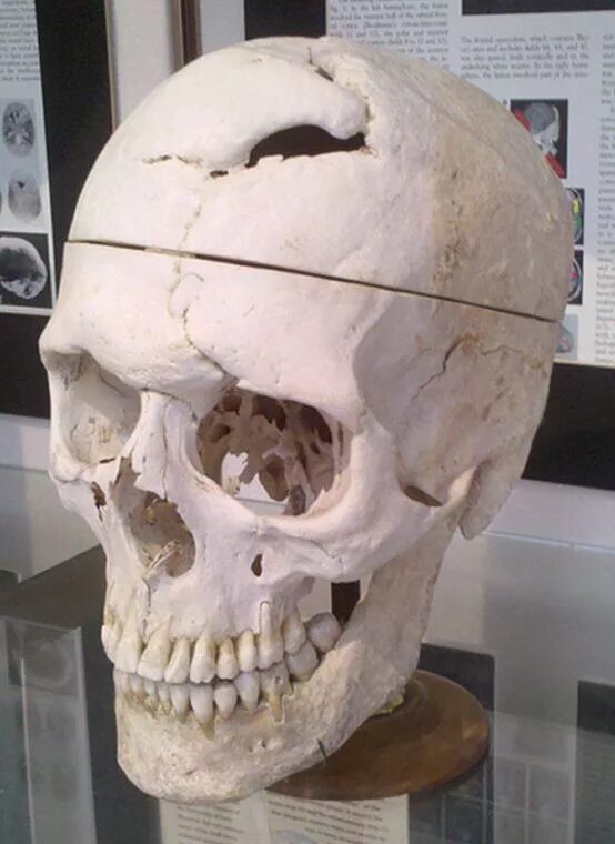 Пробитый череп фото File:Simulated Connectivity Damage of Phineas Gage SkullDisplayWarren.jpg - Wiki