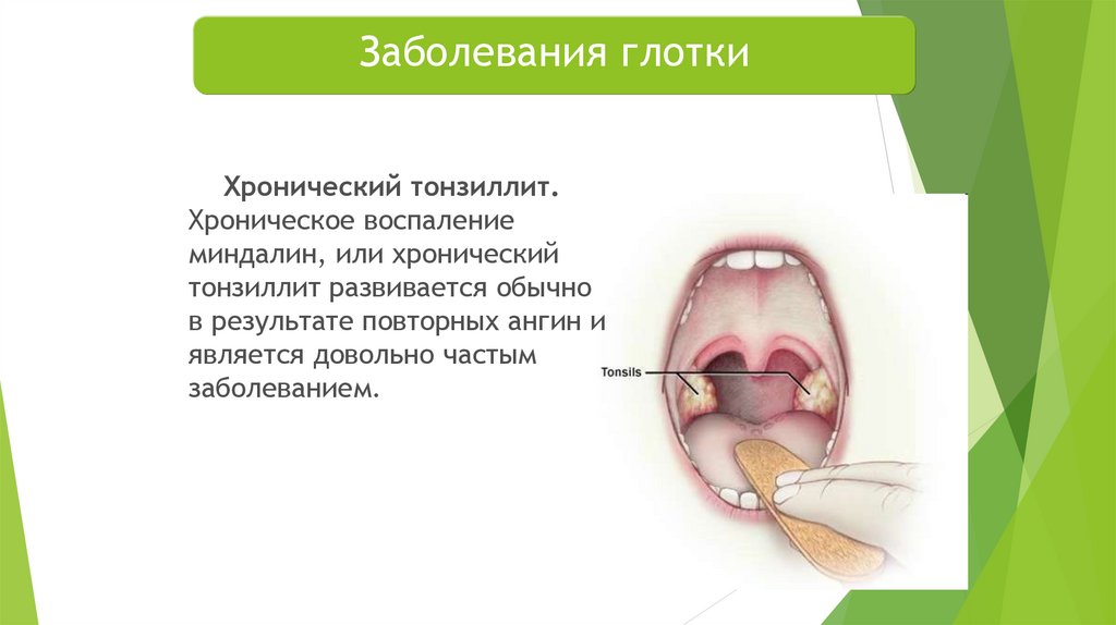 Пробка в горле у ребенка фото Патология органов речи у детей: клиническая характеристика и особенности течения