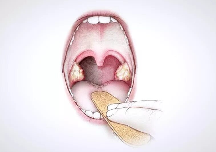 Пробка в горле у ребенка фото Налет на миндалинах
