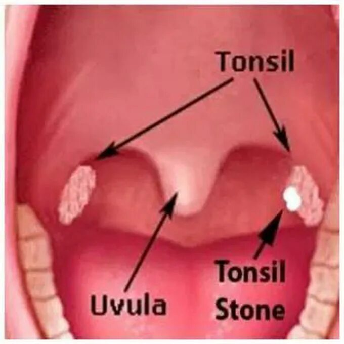 Пробки на миндалинах в горле фото Tonsil Stones - MEDizzy