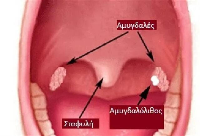 Пробки на миндалинах в горле фото Αμυγδαλόλιθοι Arcadia Portal
