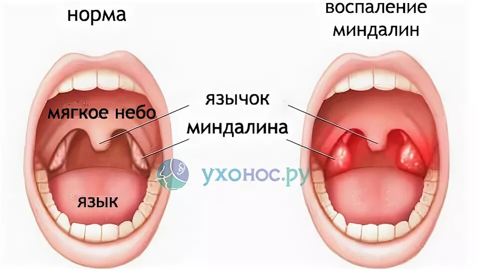 Пробки на миндалинах в горле фото Как выглядят увеличенные миндалины