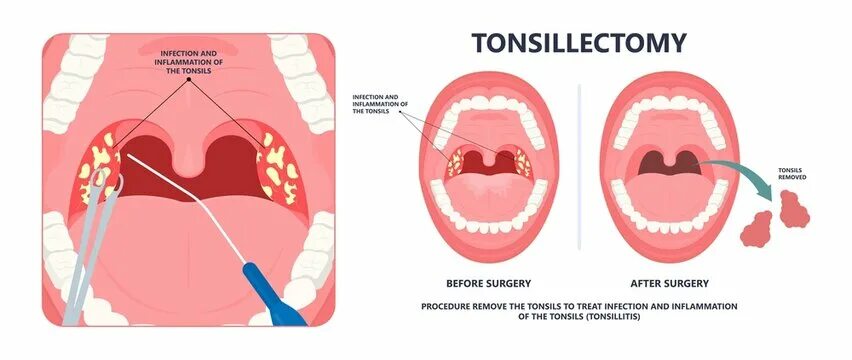 Пробки в горле фото Enlarged Tonsils Зображення - огляд 99 Стокові фото, векторні зображення й відео