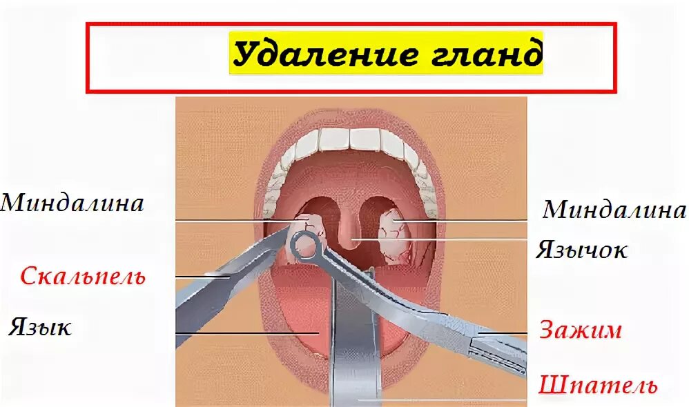 Пробки в горле фото Причины и симптомы гнойных пробок в горле. Как избавиться от гнойных пробок в го