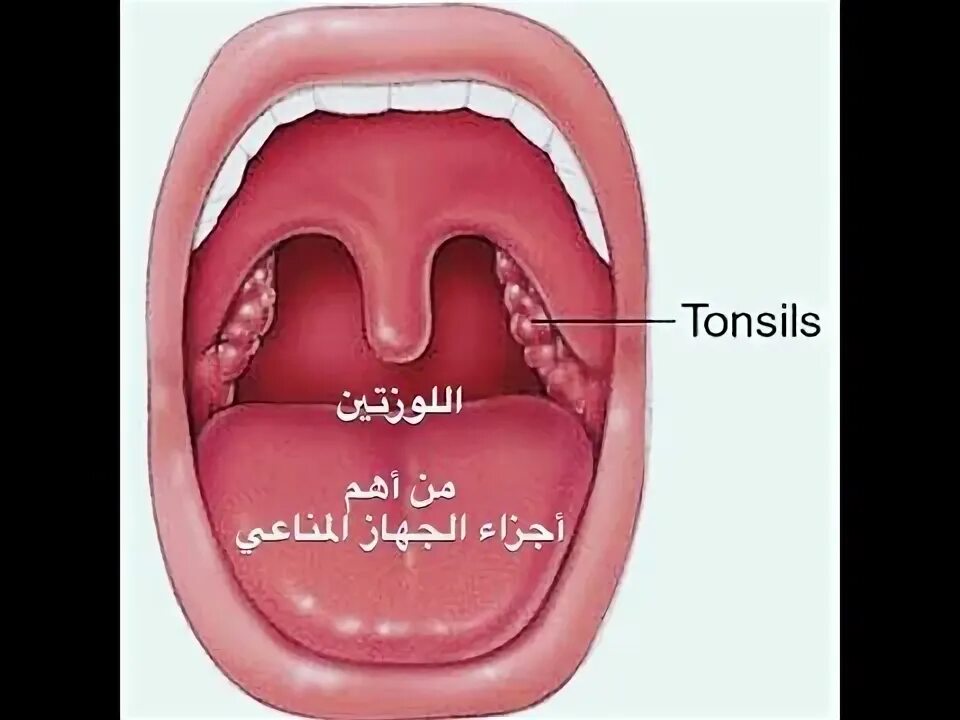 Пробки в горле фото خطأ إستئصال اللوزتين Tonsils - YouTube