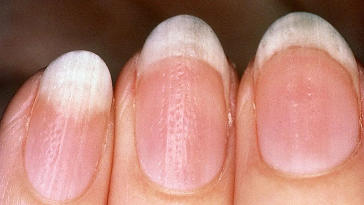 Проблемы ногтей фото What Causes Ridges in Finger & Toenails! what does it mean having vertical ridge