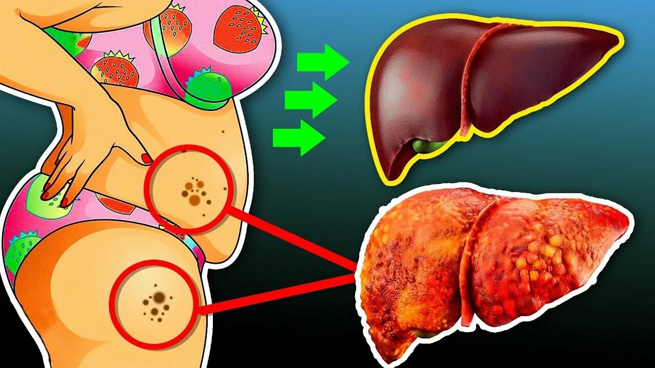 Проблемы с печенью фото 10 признаков, что ваша Печень Не Выдерживает темпа Вашей жизни! Как восстановить