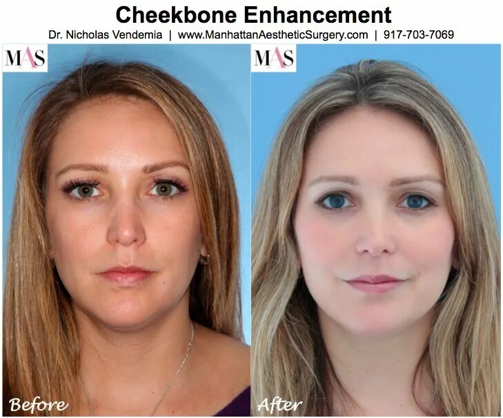 Профайл фото до и после Cheek Implants Before And After ... augmentation, fillers for cheeks, Juvederm, 