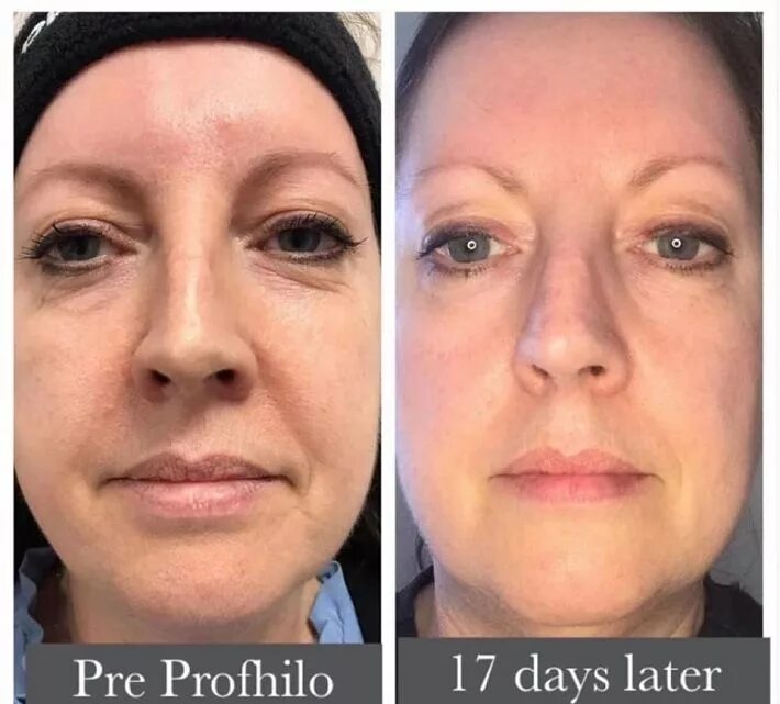 Профайло фото до и после Revitalize Your Skin with Profhilo