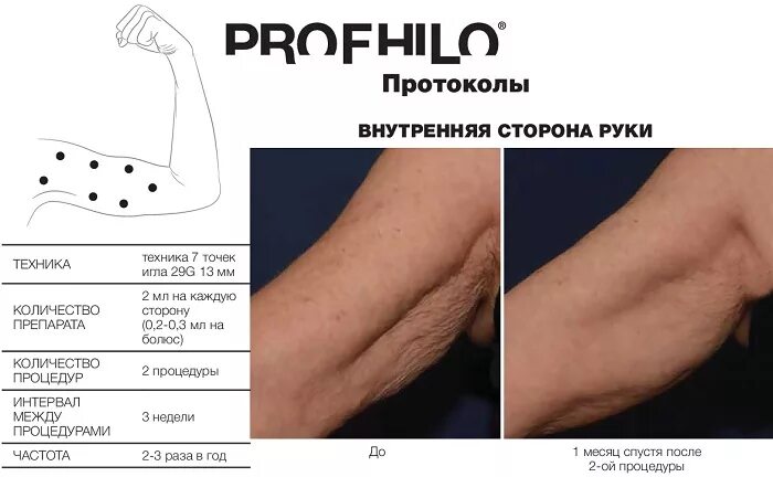 Профайло точки введения: найдено 90 изображений