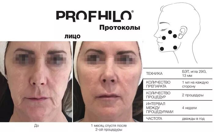 Профайло точки введения фото Естественное омоложение препаратом PROFHILO