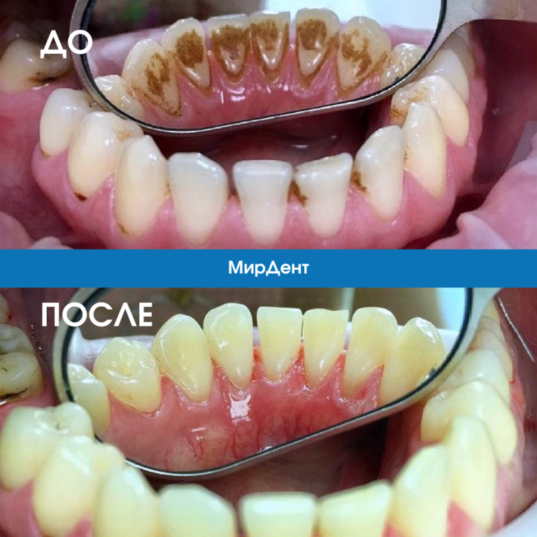 Профессиональная чистка зубов фото до и после Результаты: до и после - МирДент