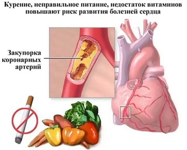 Профилактика ишемической болезни сердца фото Методическая разработка для студентов "Сестринская помощь при ИБС-стенокардии"