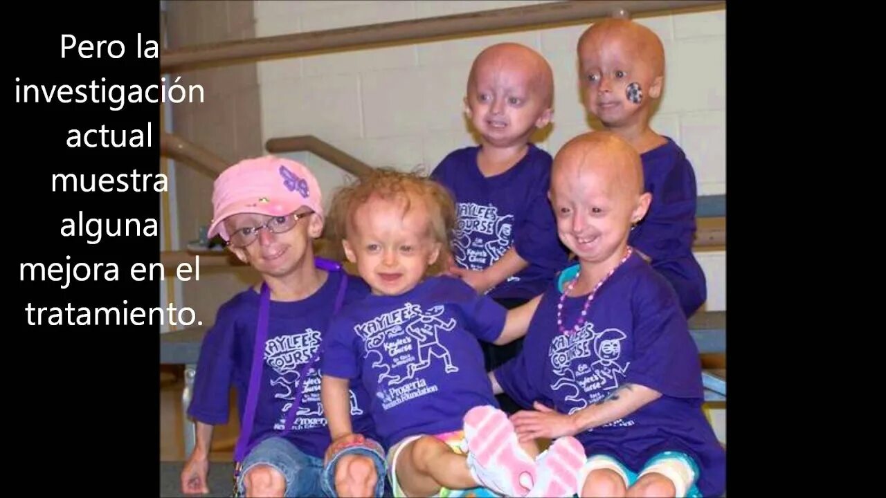 Прогерия болезнь у детей симптомы фото Enfermedad Progeria - YouTube