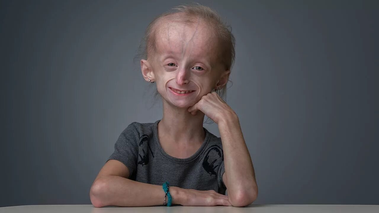 Прогерия болезнь у детей симптомы фото Miracle Story: Carly (Progeria) - YouTube