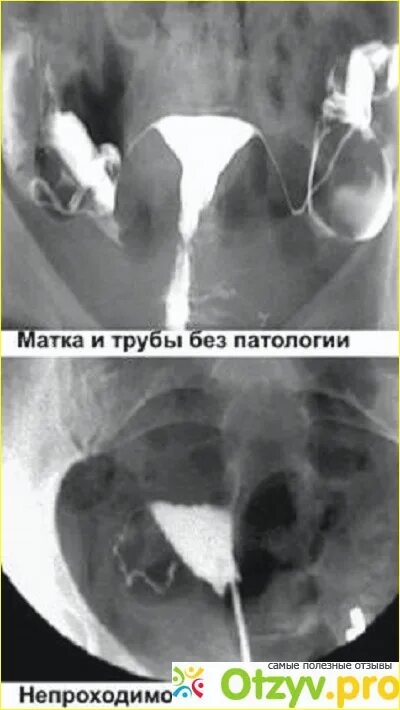 Методика гистеросальпингографии рисунок