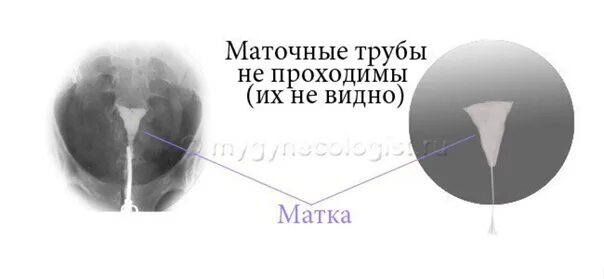 Проходимые маточные трубы фото ❗ Procedure of GISTERSALPINGOGRAPHIS (uterine tube x-ray) at VITA Medical Center