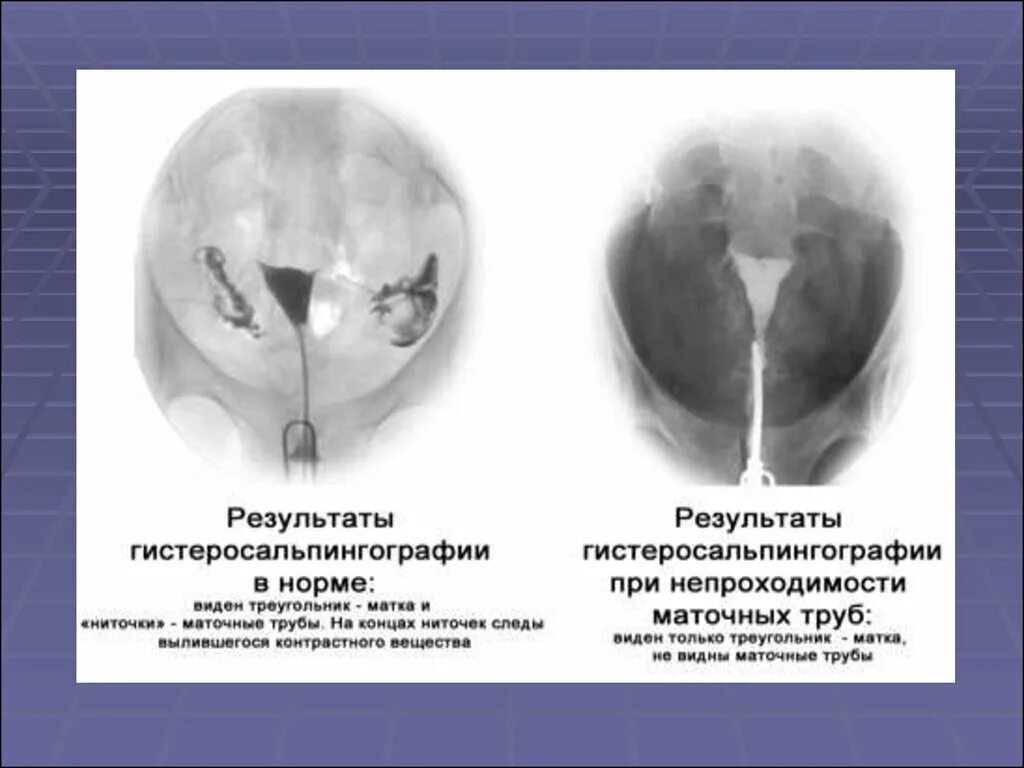 Проходимые трубы фото Методика гистеросальпингографии рисунок