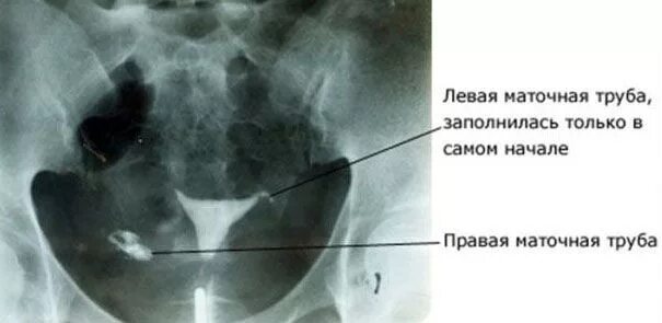 Проходимые трубы фото Непроходимость маточных труб: симптомы, лечение Операции при непроходимости труб