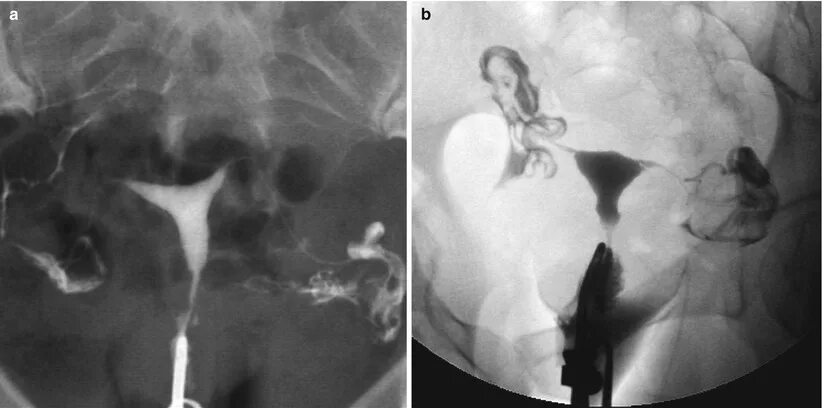 Проходимые трубы фото МПС. Radiology Key. Матка. Изменения послеоперационного периода. Радиологическая