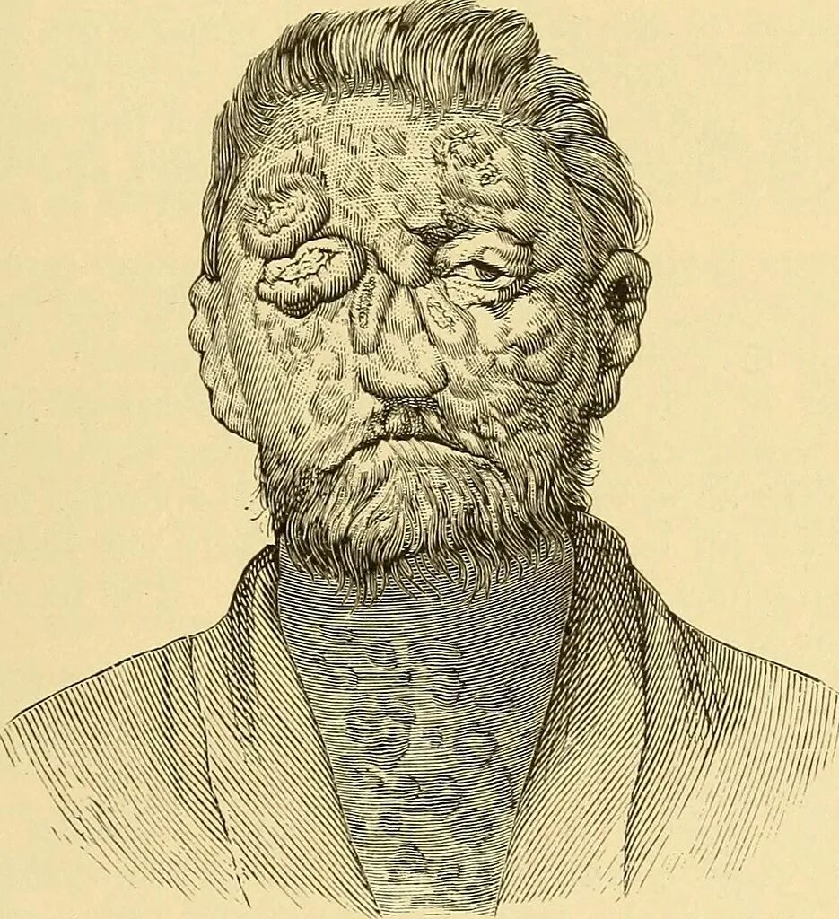 Проказа фото больных людей на поздней стадии Image from page 726 of "A practical treatise on diseases o. Flickr