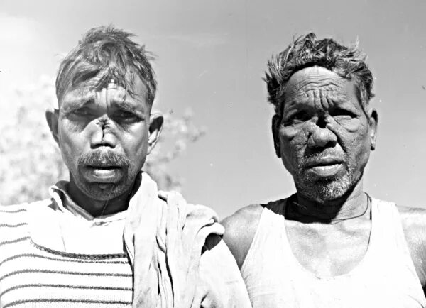 Проказа симптомы фото File:Two lepers, M.P., India, 1960 (16979054665).jpg - Wikimedia Commons