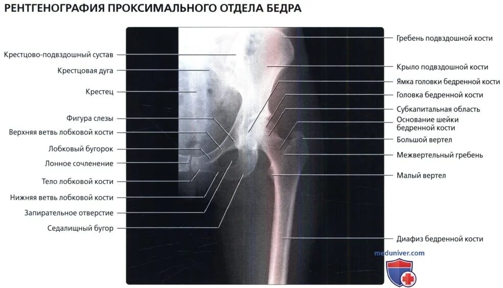 Проксимальный отдел бедренной кости фото Рентгенограмма бедра в норме