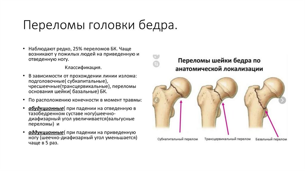 Проксимальный отдел бедренной кости фото Переломы проксимального отдела бедренной кости - презентация онлайн 7A0