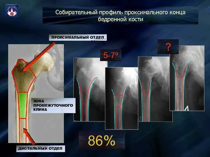 Проксимальный отдел бедренной кости фото Картинки ПРОКСИМАЛЬНОЕ БЕДРО