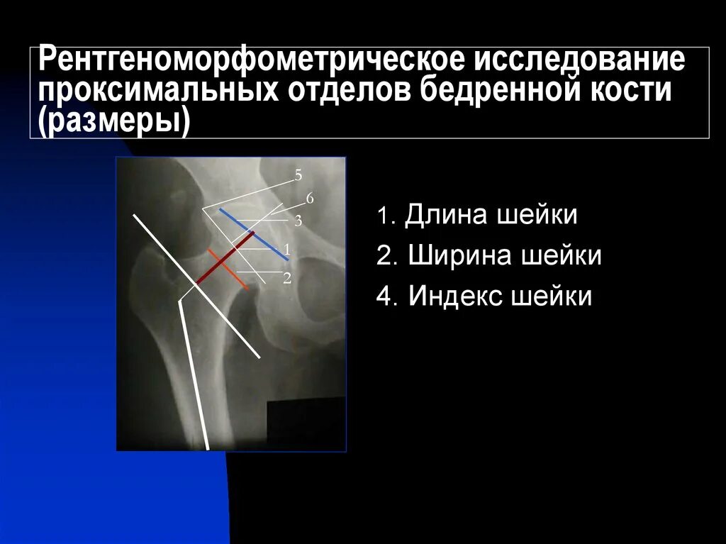 Проксимальный отдел бедренной кости фото Картинки ПРОКСИМАЛЬНОЕ БЕДРО