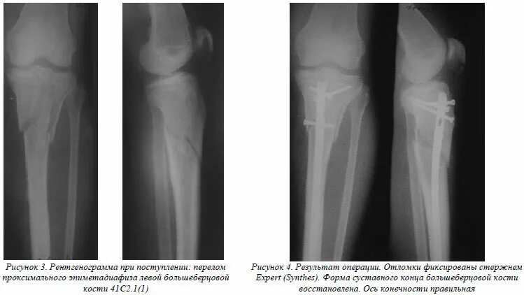 Проксимальный отдел большеберцовой кости фото Закрытый интрамедуллярный остеосинтез при лечении высоких переломов большеберцов