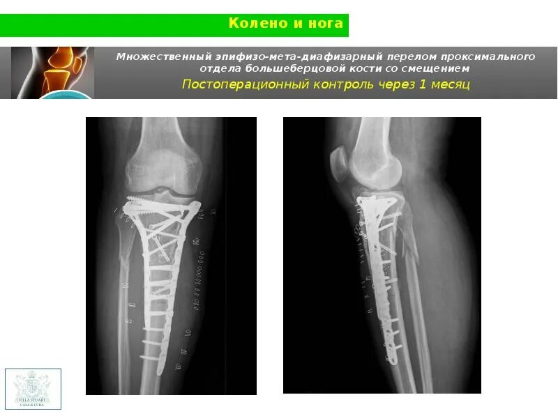 Проксимальный отдел большеберцовой кости фото Аттилио Сантуччи, PhD АНДРЕА СТАНКАТИ, MD Эрнесто Дамьано Пагано, MD Сильвио